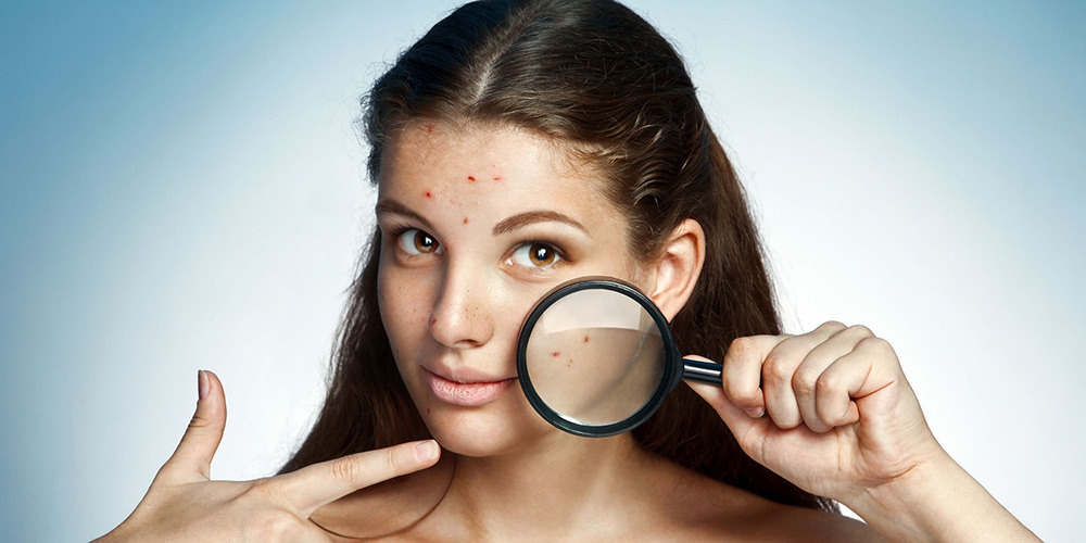 Kenali Jenis Jerawat! Dan, Lakukan Ini Untuk Mengatasinya!