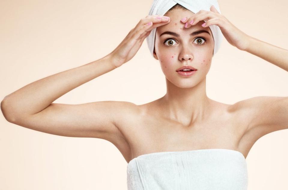 7 Penyebab Jerawat dan 10 Cara Jitu Mengatasinya