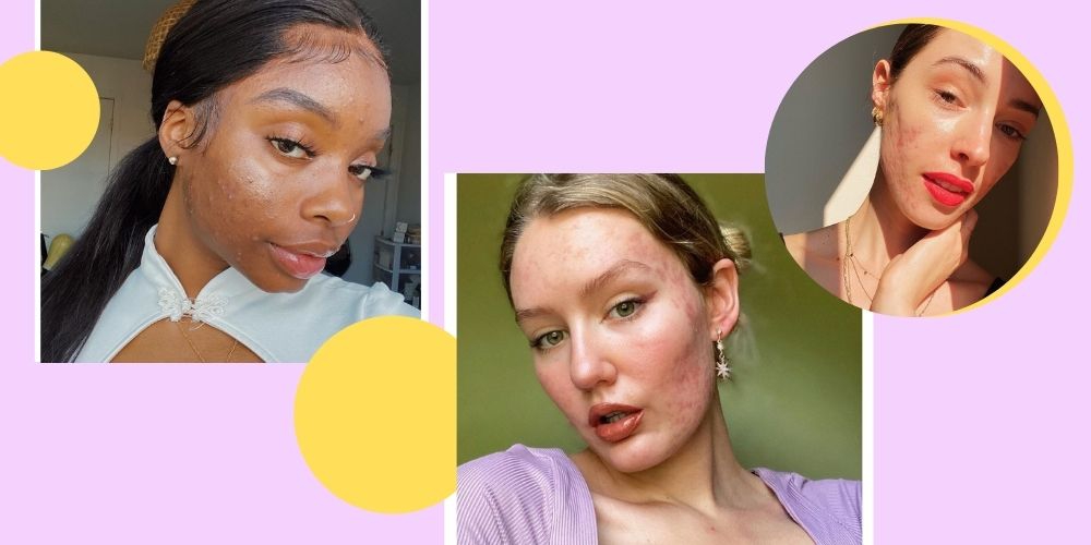 7 Acne-Positive Influencer yang Wajib Follow di Instagram