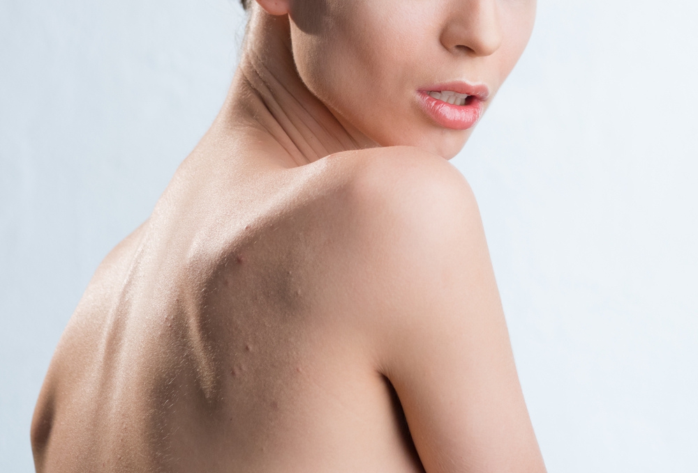 5 Penyebab Jerawat di Punggung Selalu Muncul