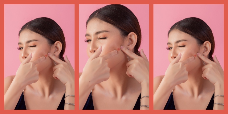 Cara Efektif Mengatasi Jerawat dengan Minyak Tea Tree