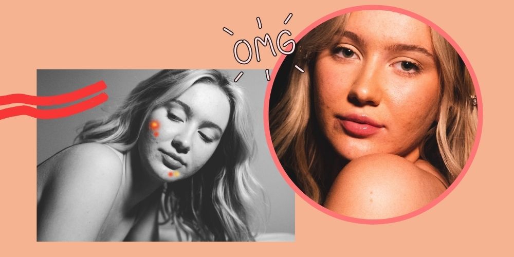 Ciri-Ciri Jerawat Hormonal dan Cara Mengatasinya