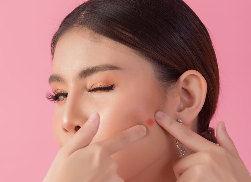 Apa Bedanya Jerawat Akibat Purging dengan Breakout? 